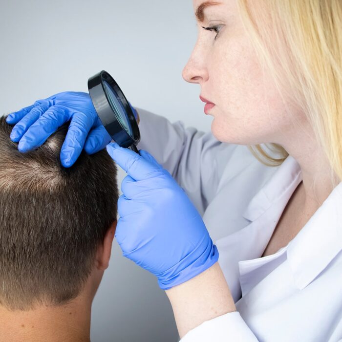 Failed Hair Transplant